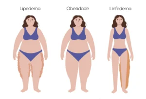Ilustração comparando lipedema, obesidade e linfedema em silhuetas femininas