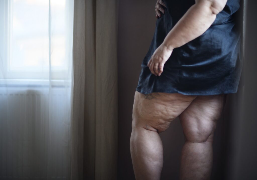 lipedema-pernas-hd