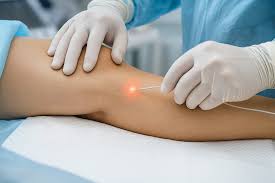Procedimento médico de aplicação de laser para tratamento de varizes